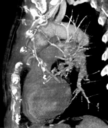 Coronary Aa Bypass Graft - CTisus CT Scan