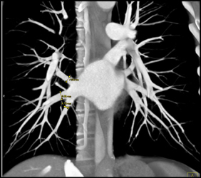 Normal Pulmonary Veins - CTisus CT Scan