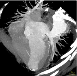 Prior Left Ventricle Infarct - CTisus CT Scan