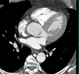 Calcification in Aortic Valve - CTisus CT Scan