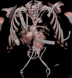 Transposition of the Great Vessels - CTisus CT Scan