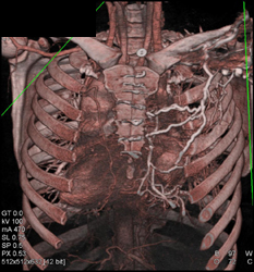 Chest Wall Collaterals - CTisus CT Scan