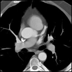 LAD Aneurysm - CTisus CT Scan