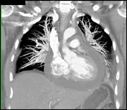 Huge Pericardial Effusion - CTisus CT Scan