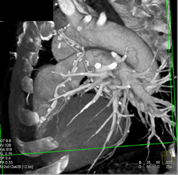 Coronary Artery Bypass - CTisus CT Scan