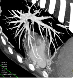 Pulmonary Arterial Venous Malformation - CTisus CT Scan