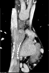 Stent in SVC - CTisus CT Scan