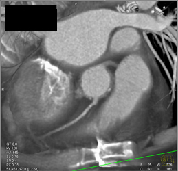 Minimal Plaque in RCA - CTisus CT Scan