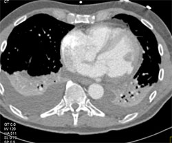 Clot in Left Ventricle - CTisus CT Scan