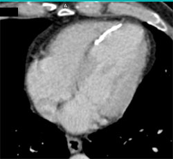 LV Infarct - CTisus CT Scan