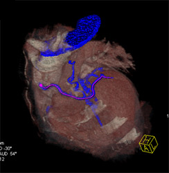 Patent Grafts - CTisus CT Scan