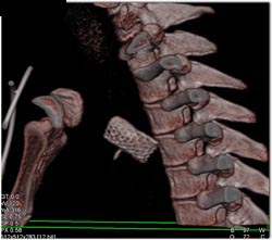 Stent for Repair of Coa - CTisus CT Scan