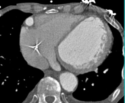 RCA Aneurysm - CTisus CT Scan