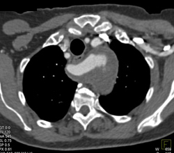 Aberrant Right Subclavian Artery With Aneurysm - CTisus CT Scan