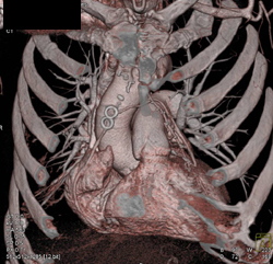 Post Coronary Artery Bypass Graft (CABG) - CTisus CT Scan