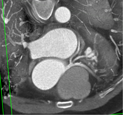 Normal Trifurcation - CTisus CT Scan