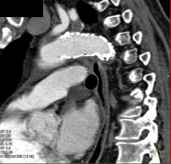 Stent in Thoracic Aorta - CTisus CT Scan