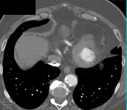 Lv Aneurysm - CTisus CT Scan