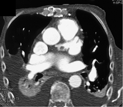 Clot in Atrial Appendage - CTisus CT Scan