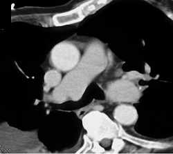 Pulmonary Sling - CTisus CT Scan