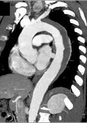 Aortic Dissection With Intramural Hematoma - CTisus CT Scan