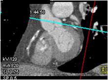 RCA Stenosis - CTisus CT Scan