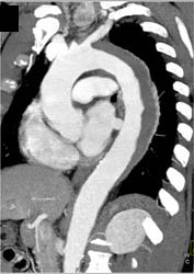 Intramural Hematoma - CTisus CT Scan