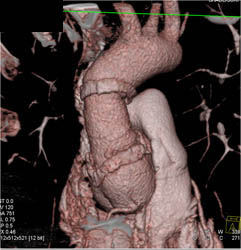 Ascending Aortic Aneurysm Repair - CTisus CT Scan