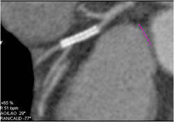 Patent Stent - CTisus CT Scan