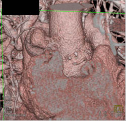 Pseudoaneurysm Off Ascending Aorta - CTisus CT Scan