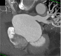 Pulmonary Vein Stenosis - CTisus CT Scan