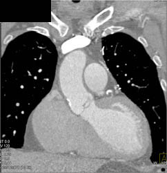 Aortic Valve Disease - CTisus CT Scan