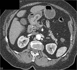 Pulmonary Embolism (PE) - CTisus CT Scan