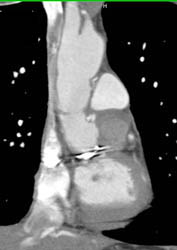 Arch Aneurysm - CTisus CT Scan