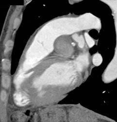 Ectatic Aorta - CTisus CT Scan