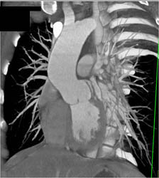 Post Coarctation of the Aorta (COA) Repair - CTisus CT Scan