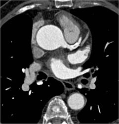 Extensive LAD Disease - CTisus CT Scan