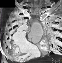 Situs Inversus - CTisus CT Scan