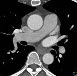 SVC Thrombus - CTisus CT Scan