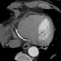 RCA Disease - CTisus CT Scan