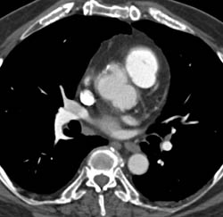 Sinus of Valsalva Aneurysm - CTisus CT Scan