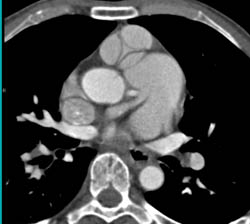 Pulmonary Artery Aneurysm - CTisus CT Scan