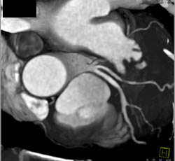 Nice Trifurcation - CTisus CT Scan