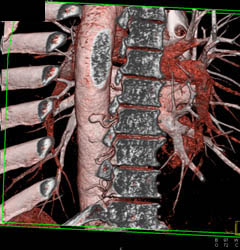 Intercostal Arteries - CTisus CT Scan