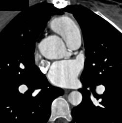 Repair of Aortic Root - CTisus CT Scan