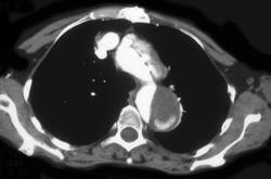 Aortic Dissection - CTisus CT Scan