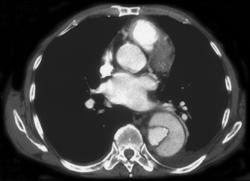 Aortic Dissection - CTisus CT Scan