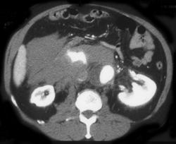 Active Bleed From Leaking Abdominal Aortic Aneurysm - CTisus CT Scan