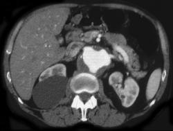 Abdominal Aortic Aneurysm - CTisus CT Scan