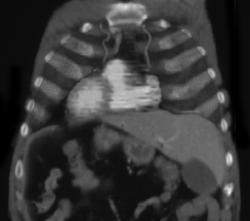 Nice Internal Mammary Artery - CTisus CT Scan